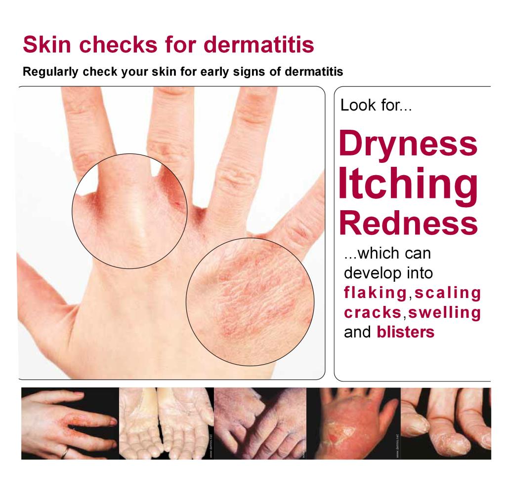 Coronavirus | preventing dermatitis 